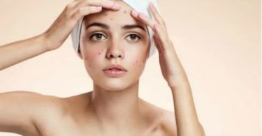 10 Effective Natural Remedies to Get Rid of Blackheads