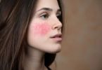 10 causes of facial redness