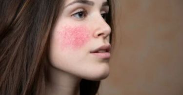 10 causes of facial redness