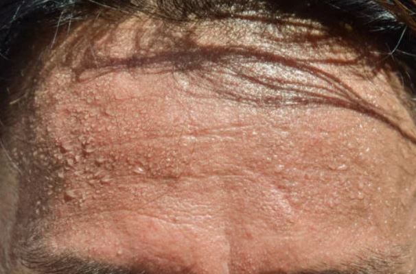 5 tips to avoid excess sweat on your head