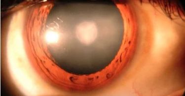 Cataract – Causes, Symptoms and Treatment