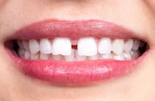 Dental diastema: what does it consist of?