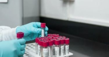 Rapid plasma reagin test for diagnosis of syphilis